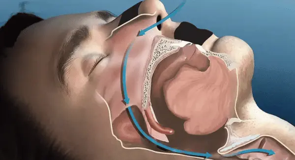 GIF showing breathing though mouth during sleep